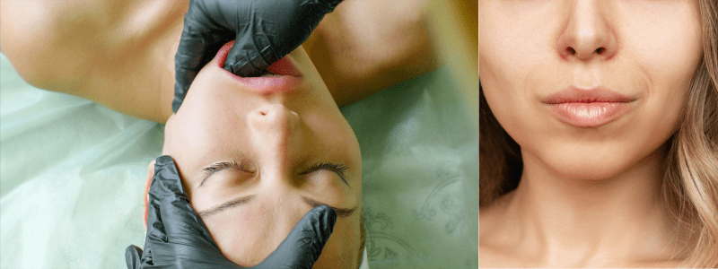 Buccal Fat Pad Removal