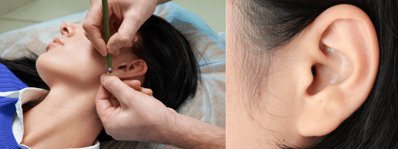 Prominent ear correction